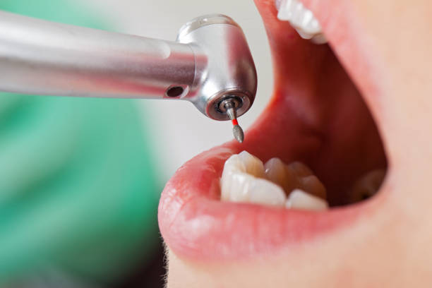 Best Emergency Dental Filling Replacement  in Beardstown, IL